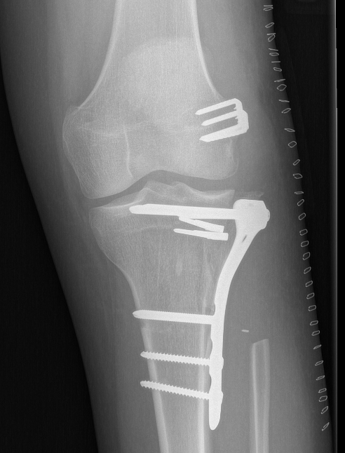 Chondrosarcoma Surgery 2